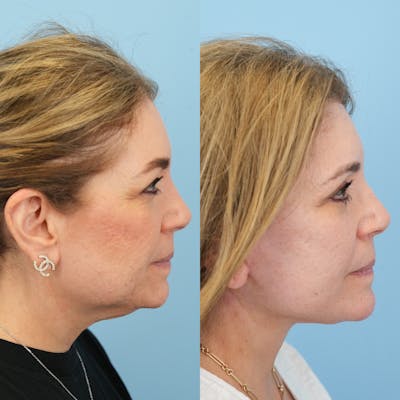 Blepharoplasty Before & After Gallery - Patient 144192 - Image 6