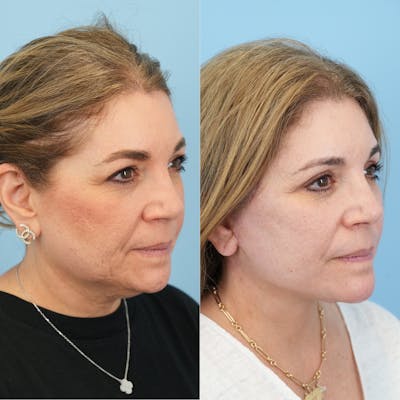 Blepharoplasty Before & After Gallery - Patient 144192 - Image 4