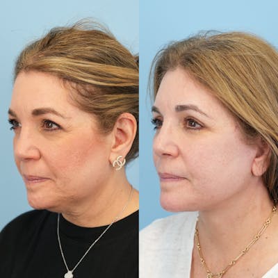 Blepharoplasty Before & After Gallery - Patient 144192 - Image 8