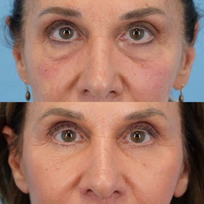 Blepharoplasty Before & After Gallery - Patient 398964 - Image 1