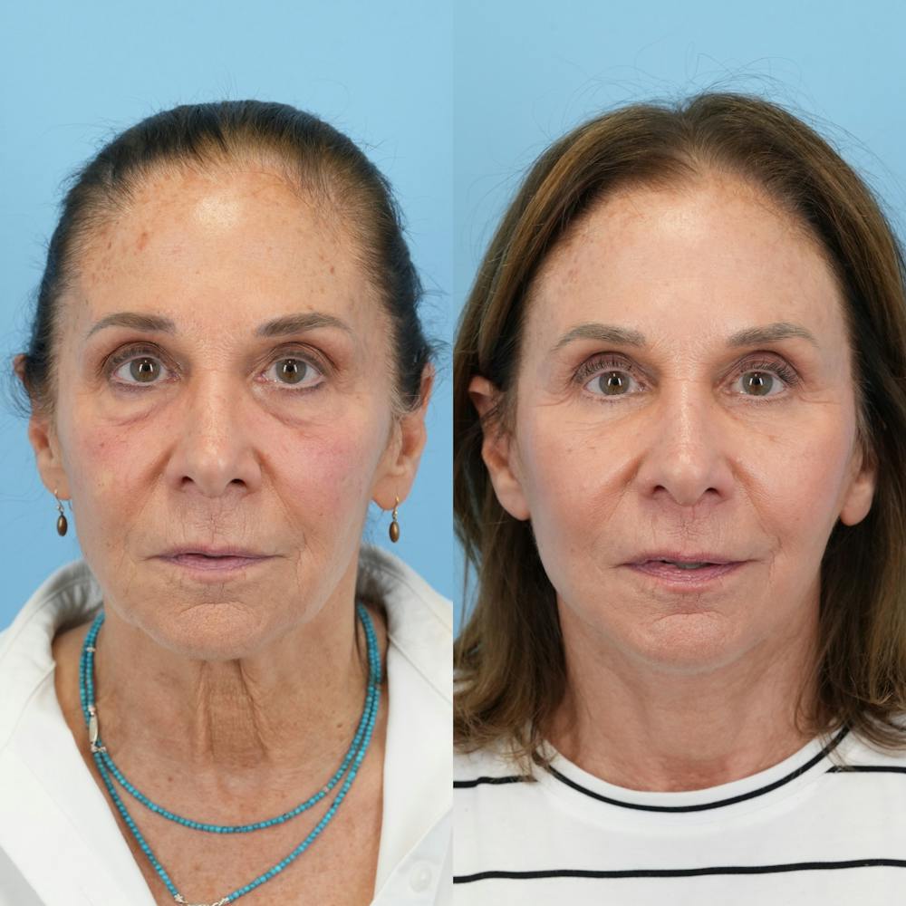 Facelift Before & After Gallery - Patient 421049 - Image 1