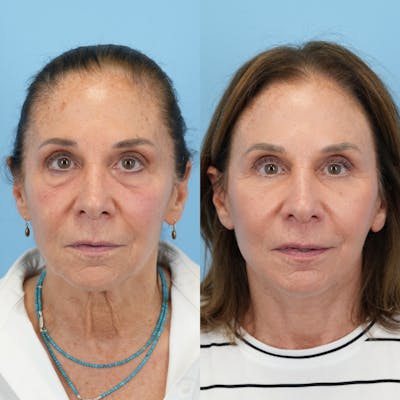 Facelift Before & After Gallery - Patient 421049 - Image 1
