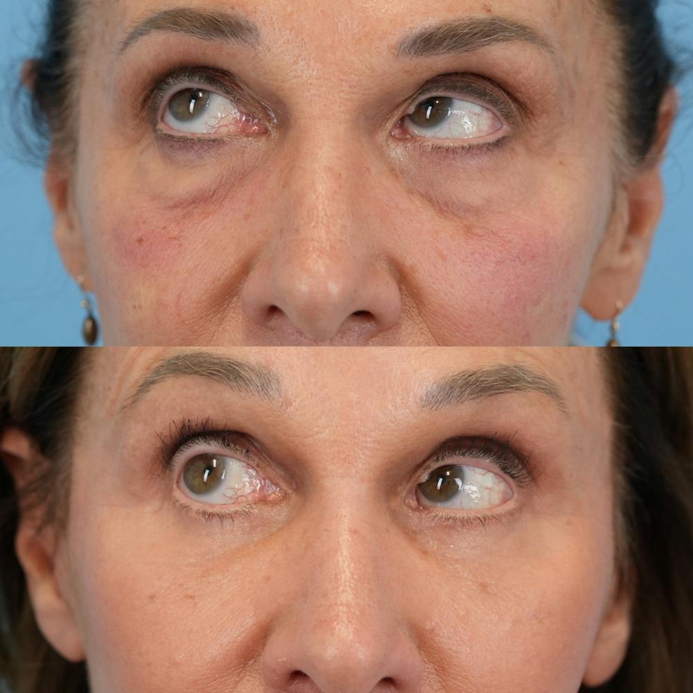 Facelift Before & After Gallery - Patient 421049 - Image 9