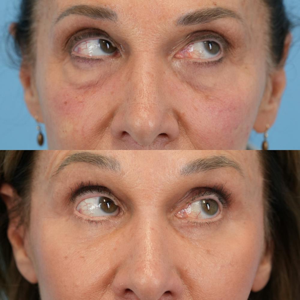 Facelift Before & After Gallery - Patient 421049 - Image 8