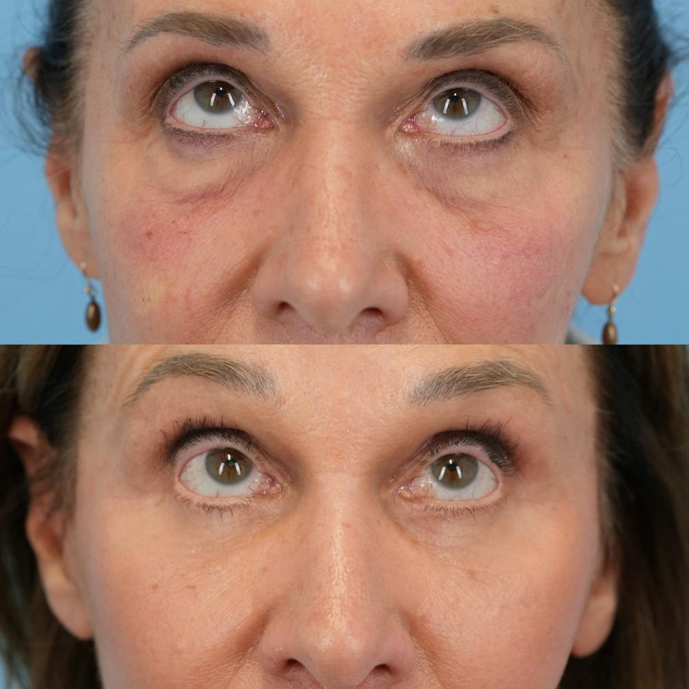Facelift Before & After Gallery - Patient 421049 - Image 7