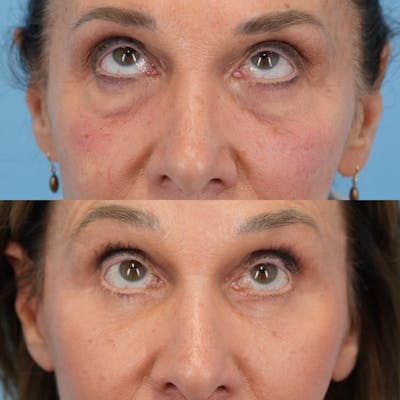 Blepharoplasty Before & After Gallery - Patient 398964 - Image 2
