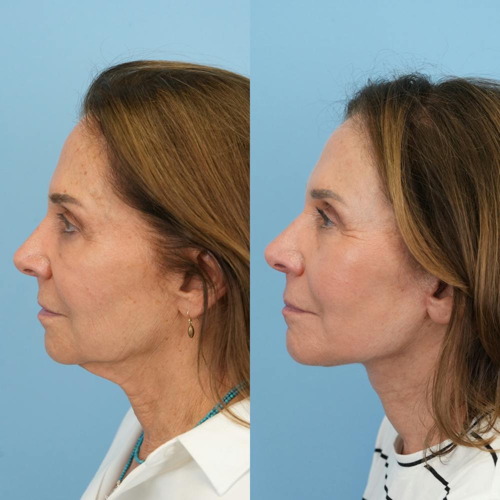 Facelift Before & After Gallery - Patient 421049 - Image 5