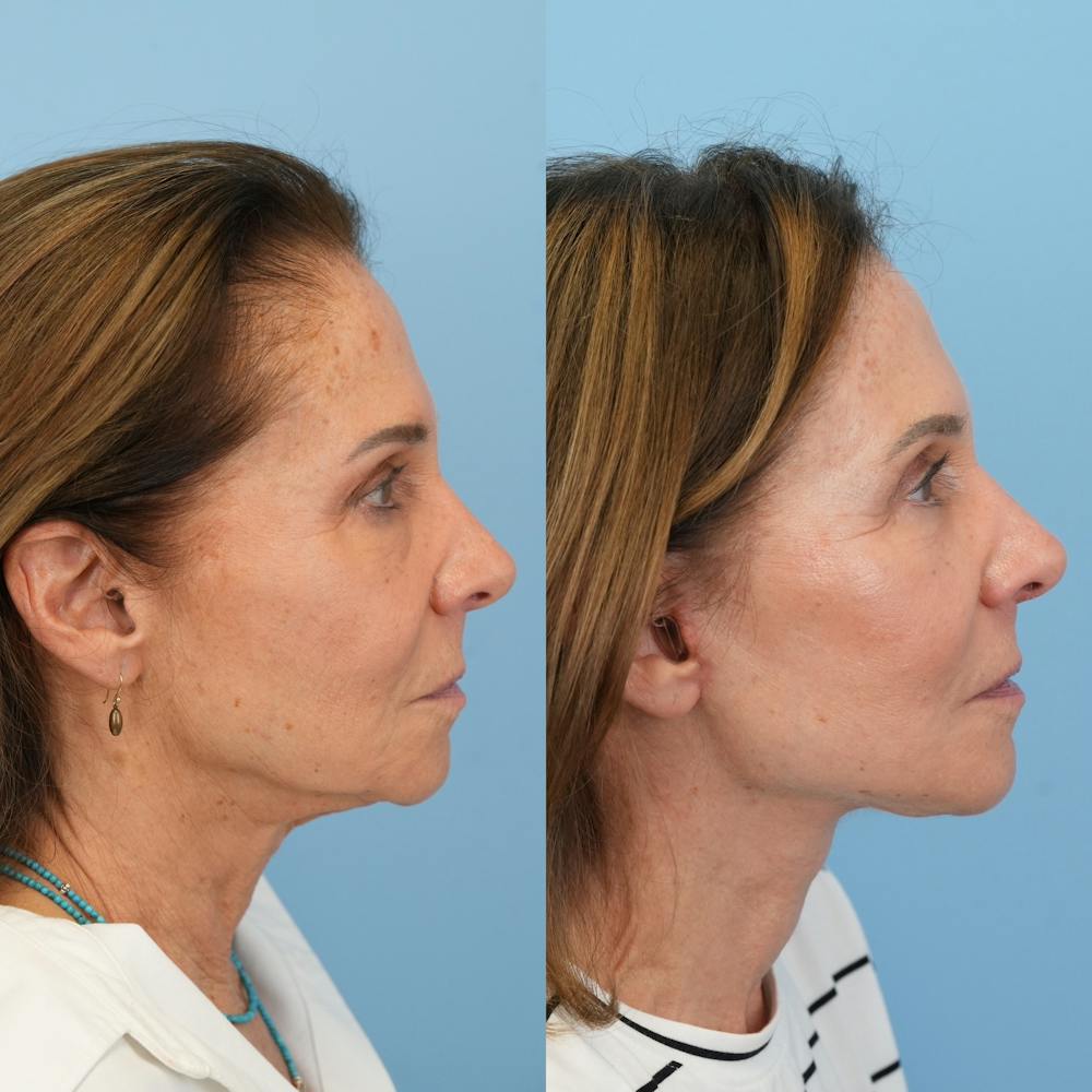 Facelift Before & After Gallery - Patient 421049 - Image 3