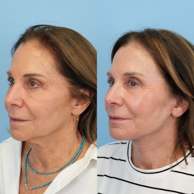 Facelift Before & After Gallery - Patient 421049 - Image 4
