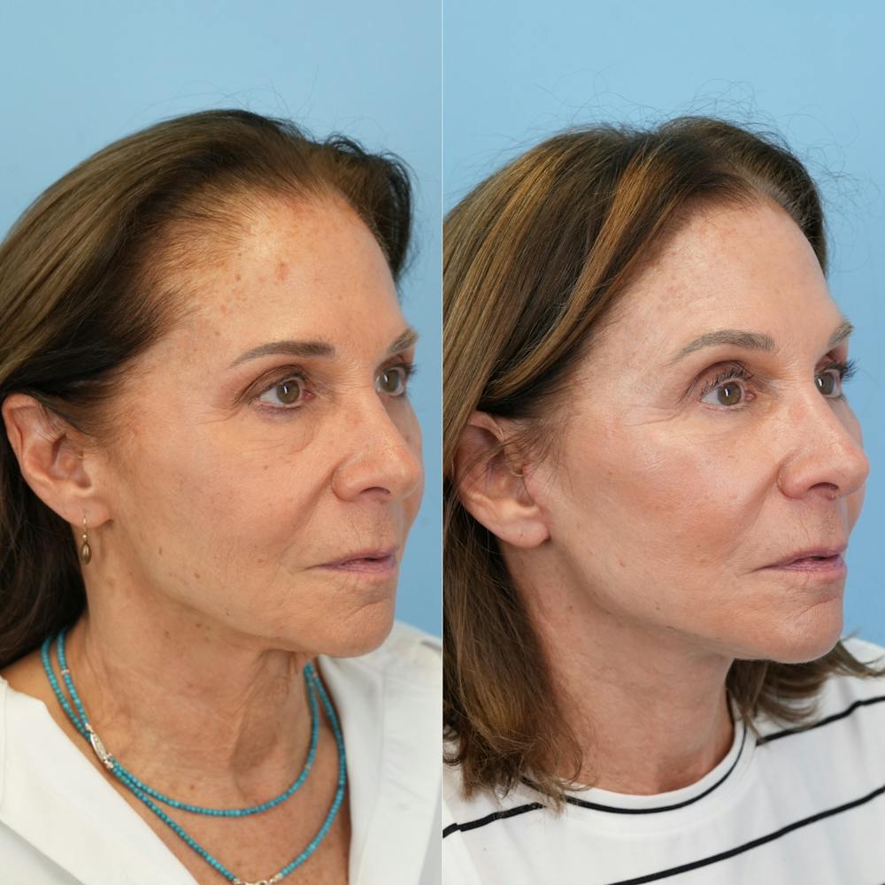 Facelift Before & After Gallery - Patient 421049 - Image 2