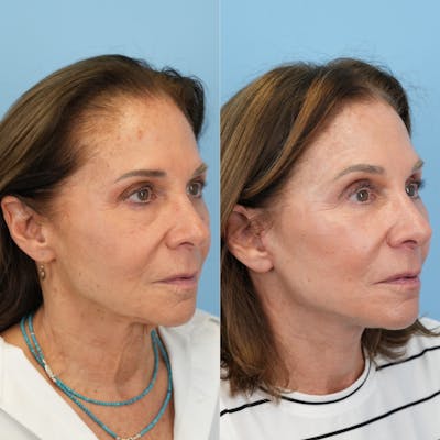 Facelift Before & After Gallery - Patient 421049 - Image 2