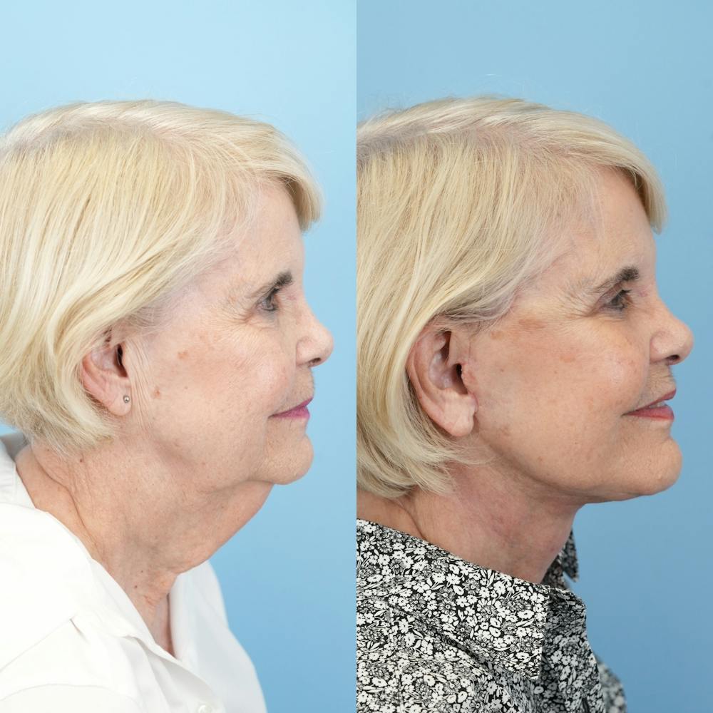 Facelift Before & After Gallery - Patient 166209 - Image 3