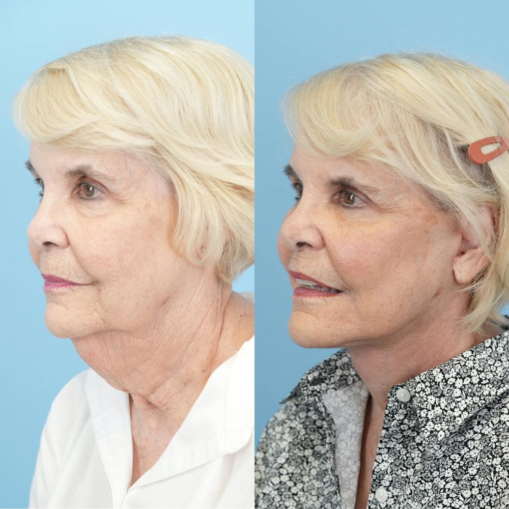 Facelift Before & After Gallery - Patient 166209 - Image 4