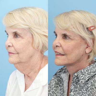 Facelift Before & After Gallery - Patient 166209 - Image 4