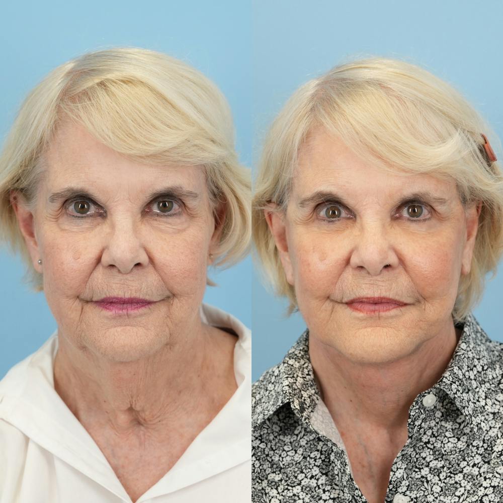 Facelift Before & After Gallery - Patient 166209 - Image 1