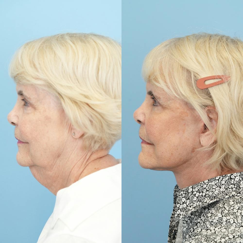 Facelift Before & After Gallery - Patient 166209 - Image 5
