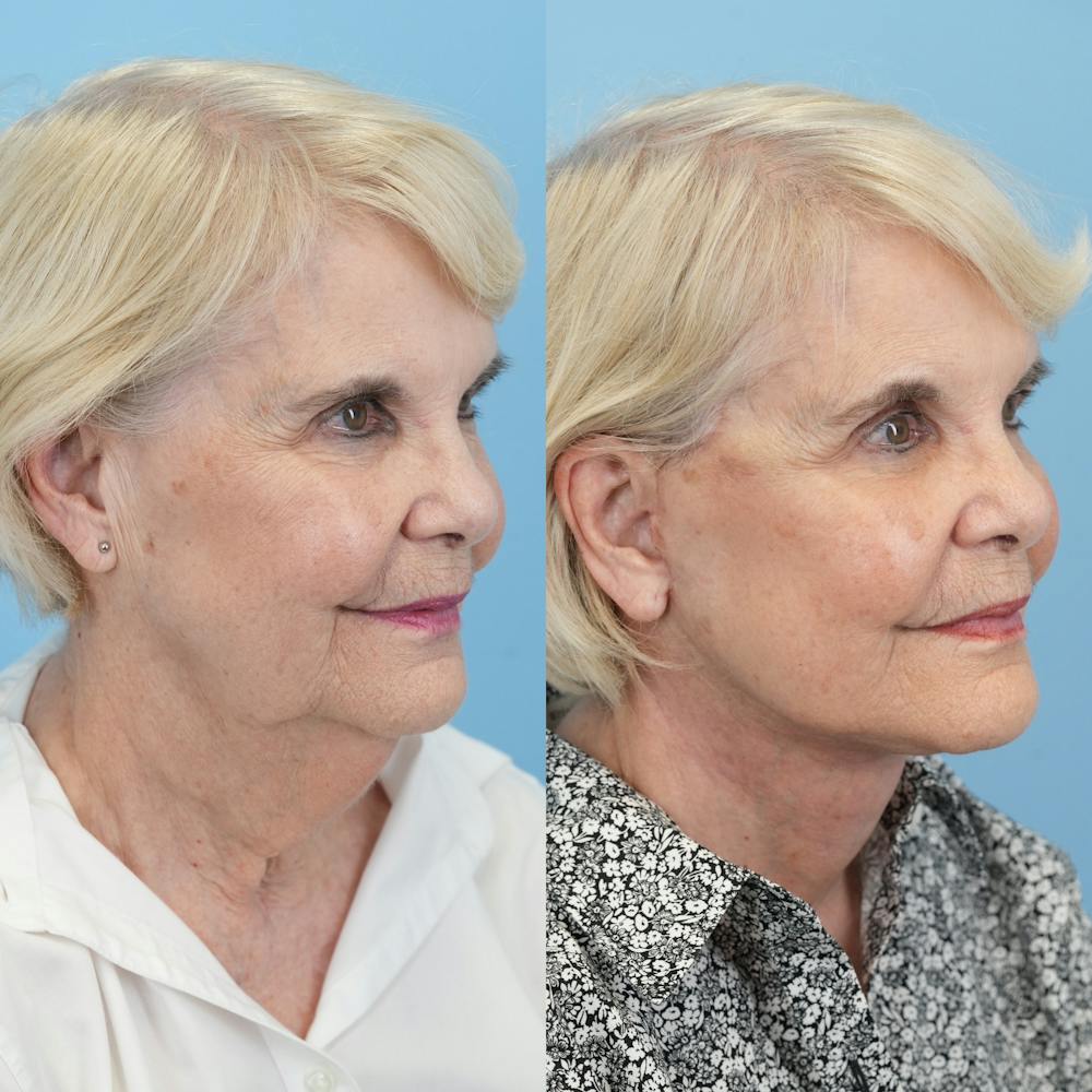 Facelift Before & After Gallery - Patient 166209 - Image 2