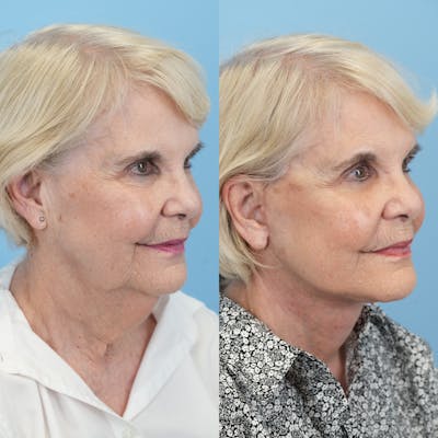 Facelift Before & After Gallery - Patient 166209 - Image 2