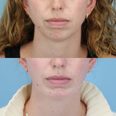Buccal Fat Excision Before & After Gallery - Patient 113990 - Image 2