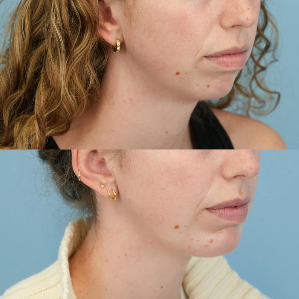 Buccal Fat Excision Before & After Gallery - Patient 113990 - Image 3