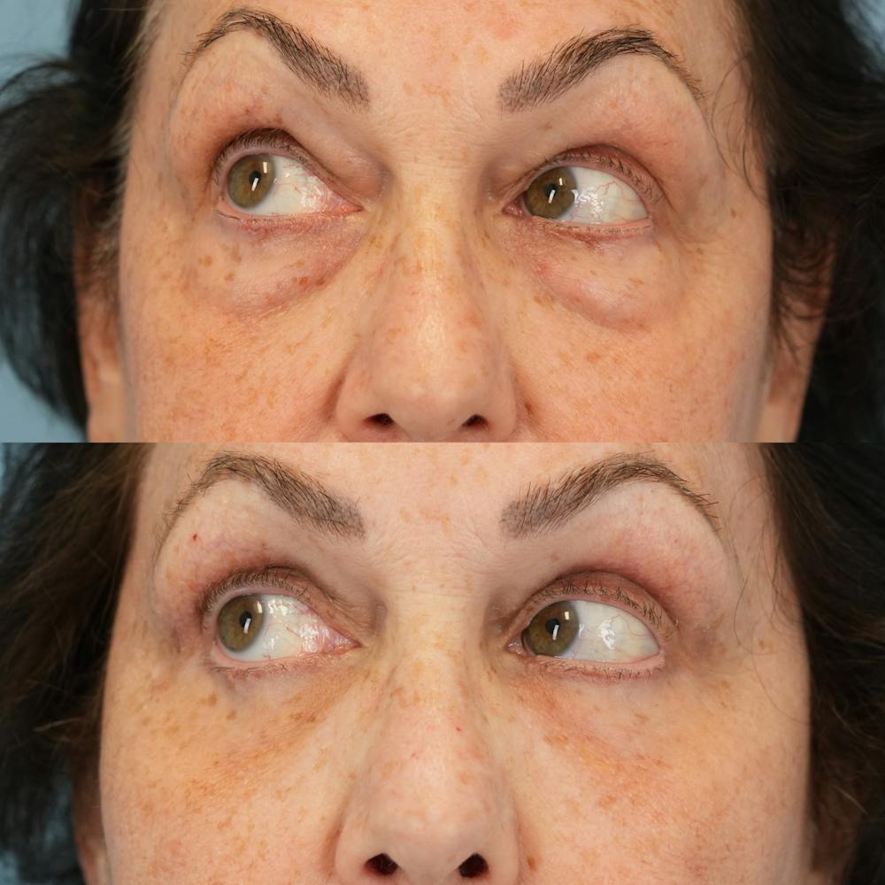 Blepharoplasty Before & After Gallery - Patient 305783 - Image 4