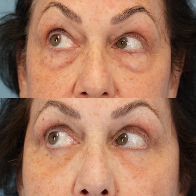 Blepharoplasty Before & After Gallery - Patient 305783 - Image 4