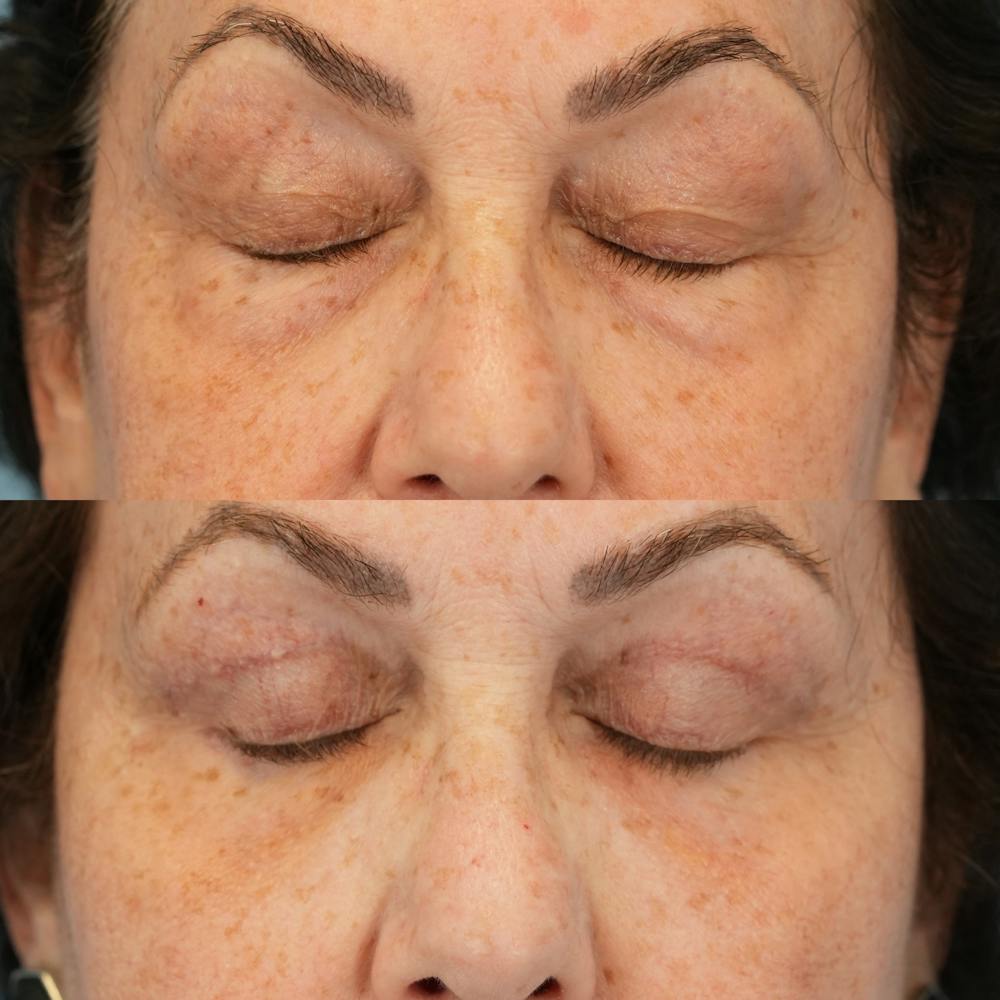 Blepharoplasty Before & After Gallery - Patient 305783 - Image 5
