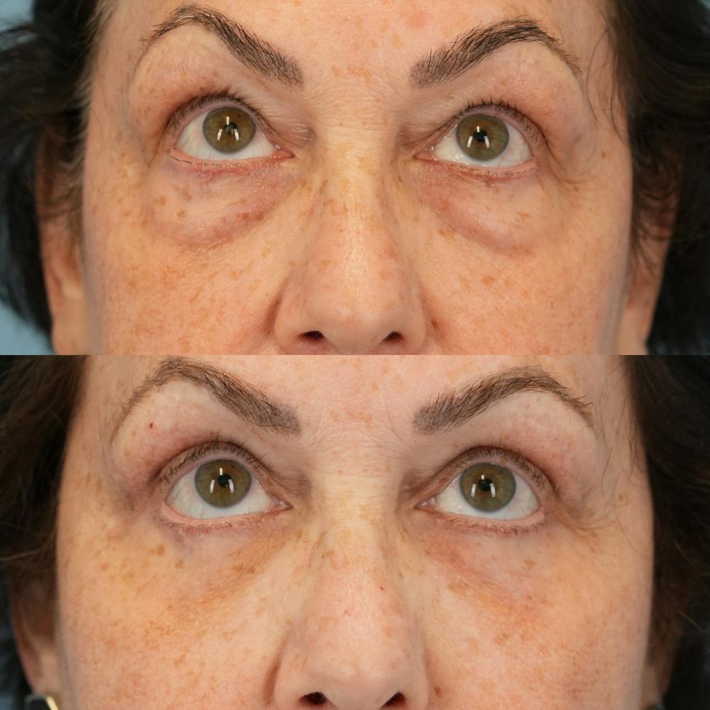 Blepharoplasty Before & After Gallery - Patient 305783 - Image 2