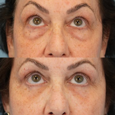 Blepharoplasty Before & After Gallery - Patient 305783 - Image 2