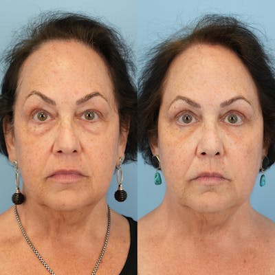 Blepharoplasty Before & After Gallery - Patient 305783 - Image 6