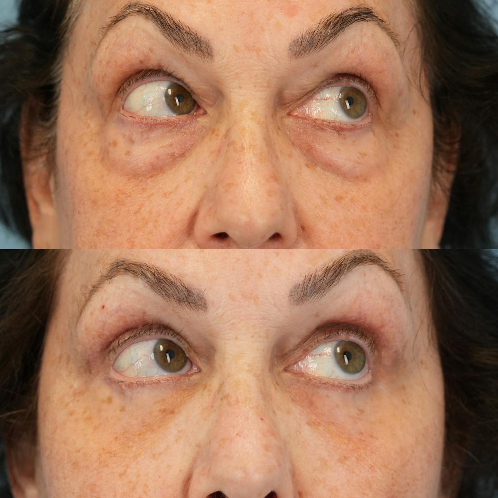 Blepharoplasty Before & After Gallery - Patient 305783 - Image 3