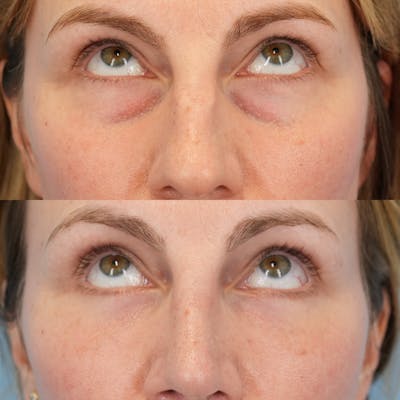 Blepharoplasty Before & After Gallery - Patient 584087 - Image 2