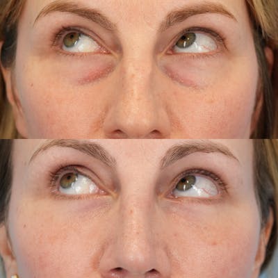 Blepharoplasty Before & After Gallery - Patient 584087 - Image 4