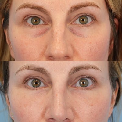Blepharoplasty Before & After Gallery - Patient 584087 - Image 1