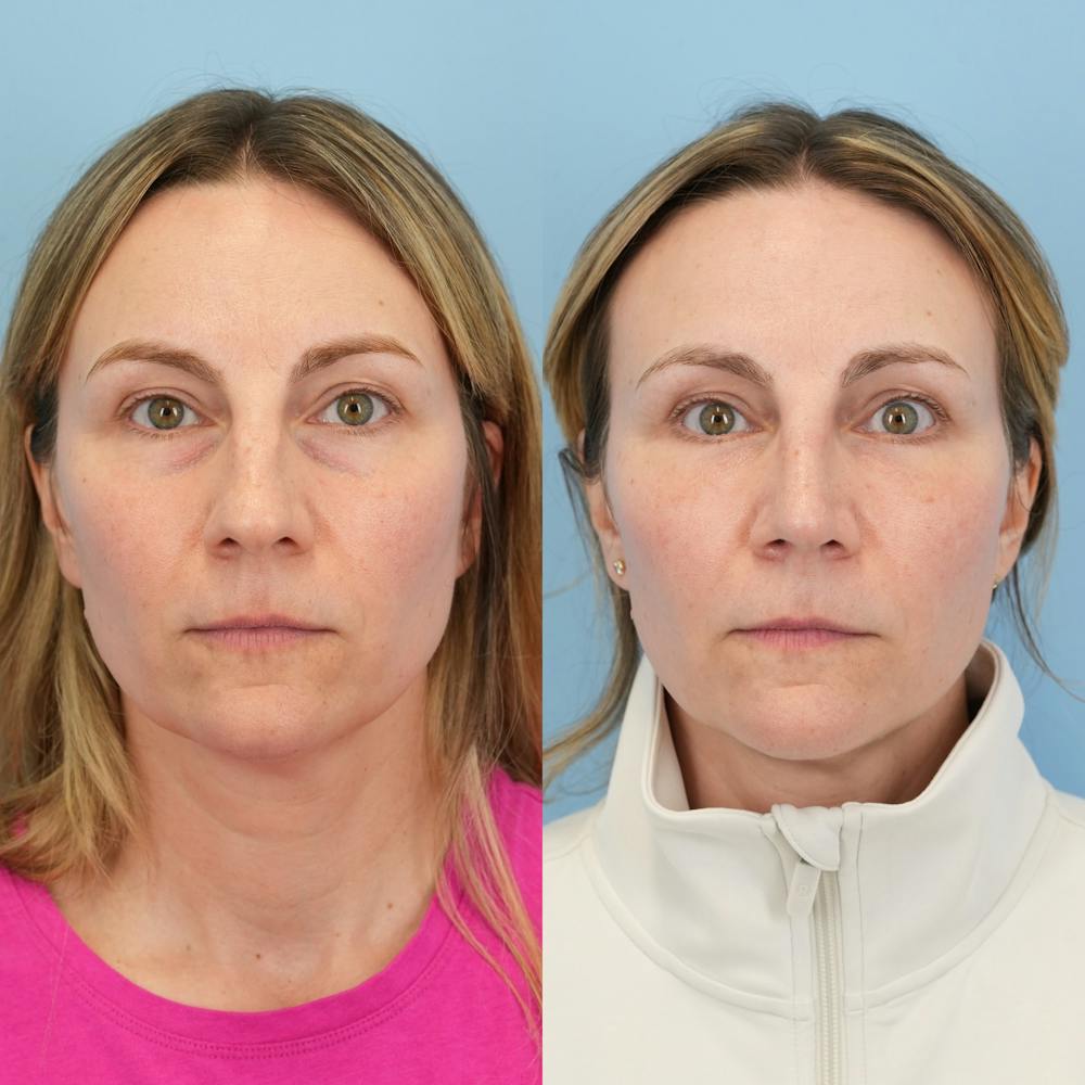 Blepharoplasty Before & After Gallery - Patient 584087 - Image 5