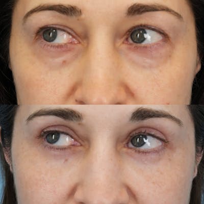 Blepharoplasty Before & After Gallery - Patient 262920 - Image 4