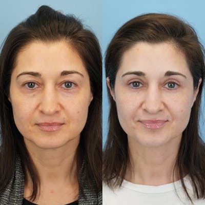 Blepharoplasty Before & After Gallery - Patient 262920 - Image 6