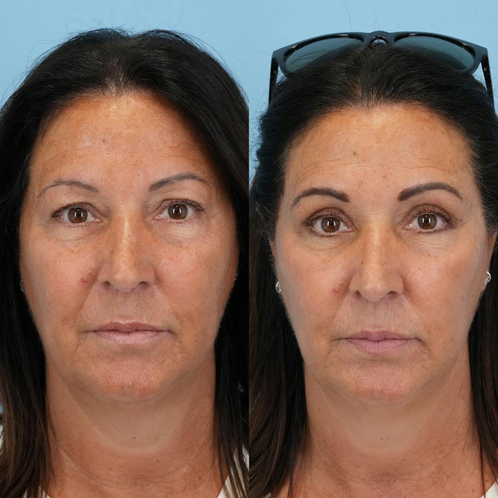 Blepharoplasty Before & After Gallery - Patient 348400 - Image 3