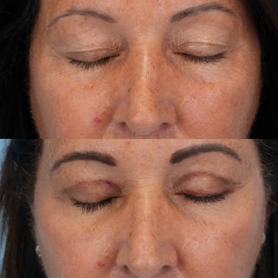 Blepharoplasty Before & After Gallery - Patient 348400 - Image 2