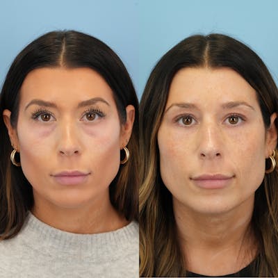 Blepharoplasty Before & After Gallery - Patient 386799 - Image 6