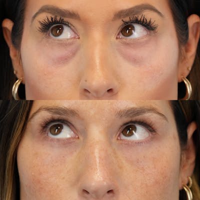 Blepharoplasty Before & After Gallery - Patient 386799 - Image 4