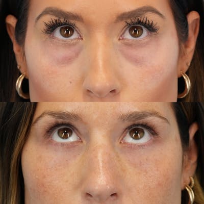 Blepharoplasty Before & After Gallery - Patient 386799 - Image 2