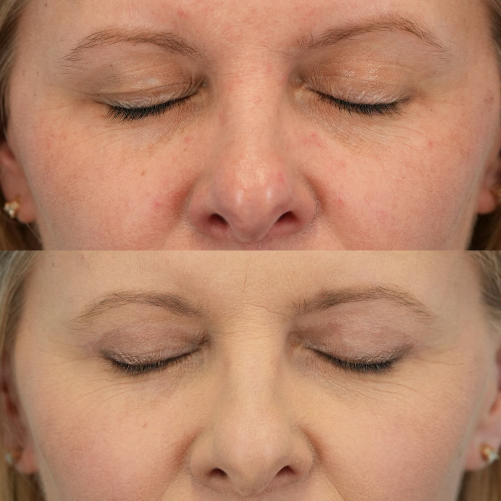 Upper Eyelids Before & After Gallery - Patient 165569 - Image 2
