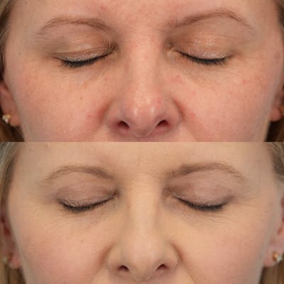 Upper Eyelids Before & After Gallery - Patient 165569 - Image 2