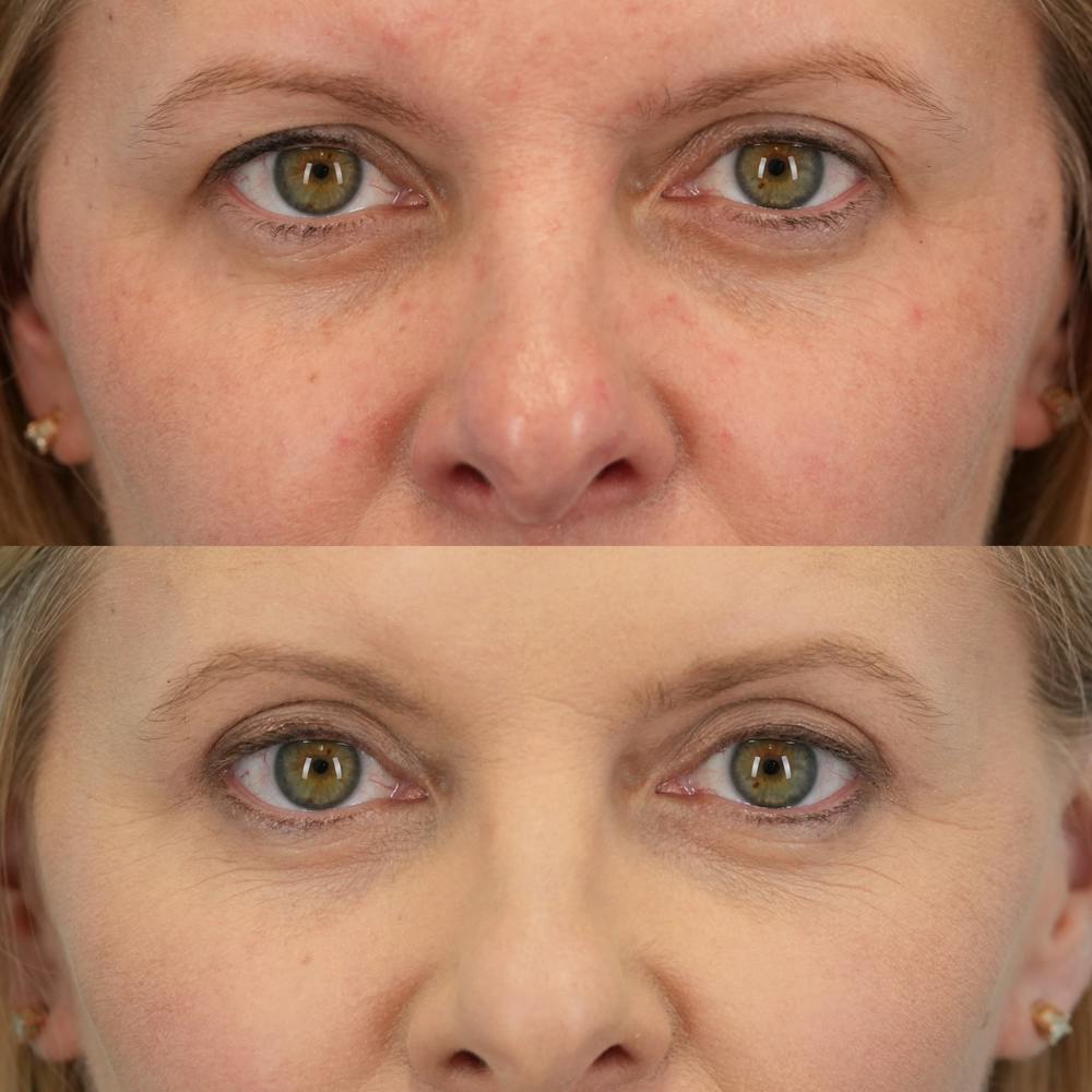 Upper Eyelids Before & After Gallery - Patient 165569 - Image 1