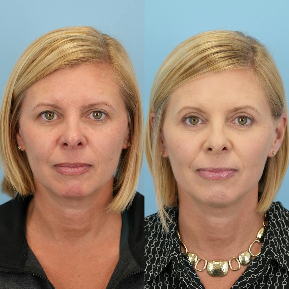 Upper Eyelids Before & After Gallery - Patient 165569 - Image 3