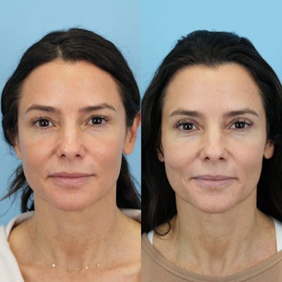 Upper Eyelids Before & After Gallery - Patient 402068 - Image 2