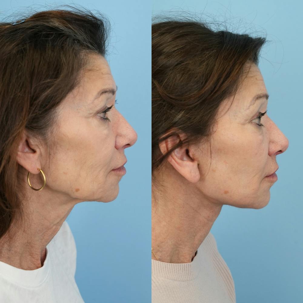 Facelift Before & After Gallery - Patient 414850 - Image 3