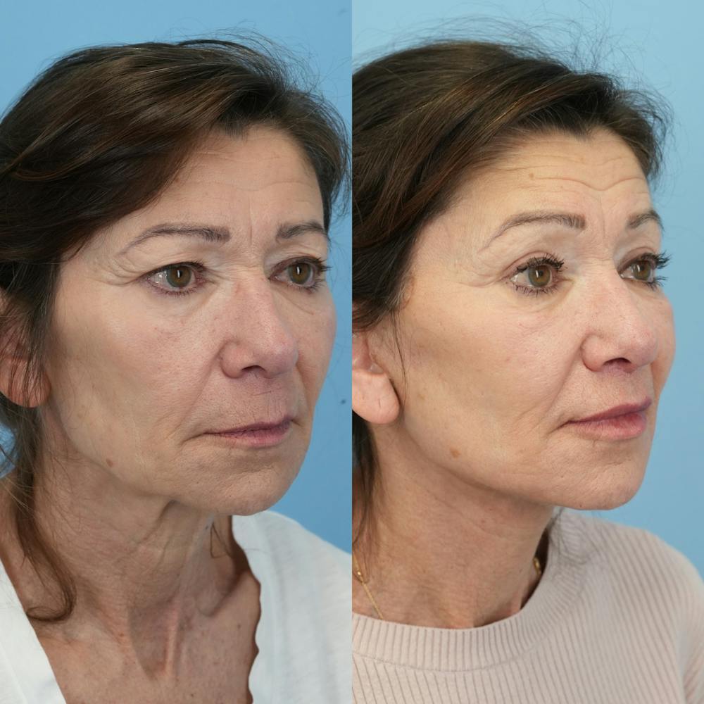 Facelift Before & After Gallery - Patient 414850 - Image 2