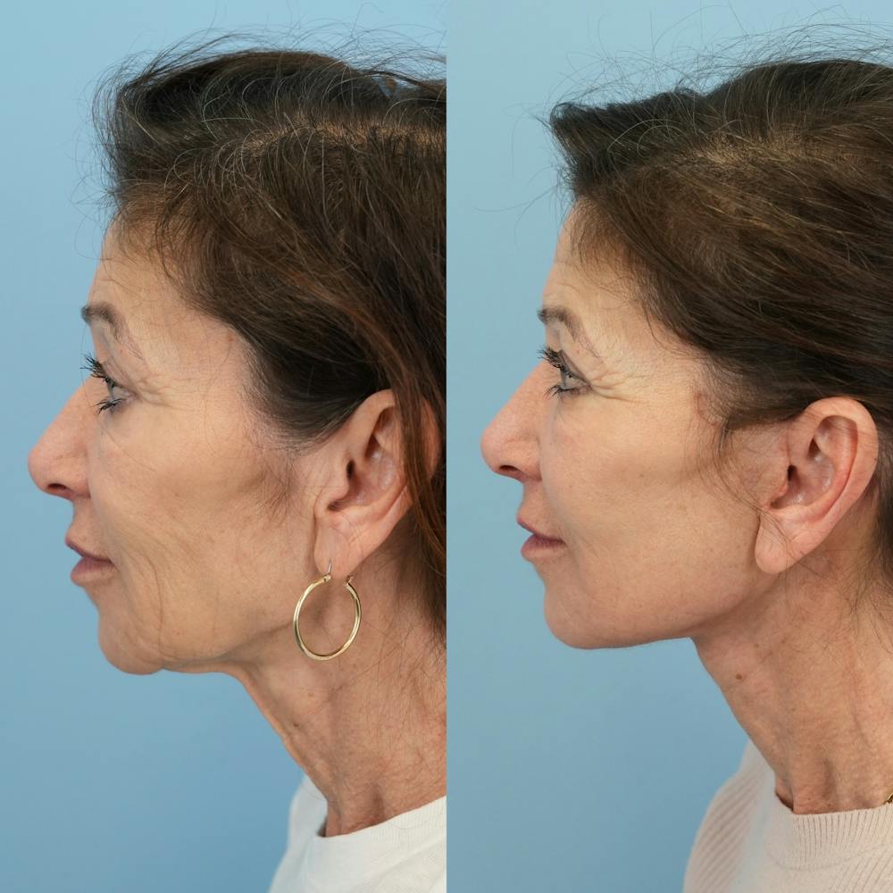 Facelift Before & After Gallery - Patient 414850 - Image 5